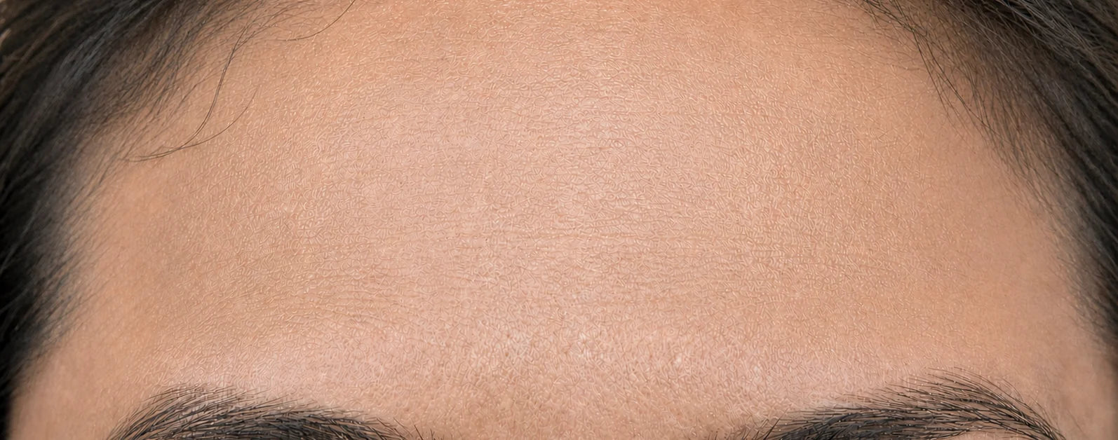 The same forehead after fourteen nights: smoother, with softer-looking lines