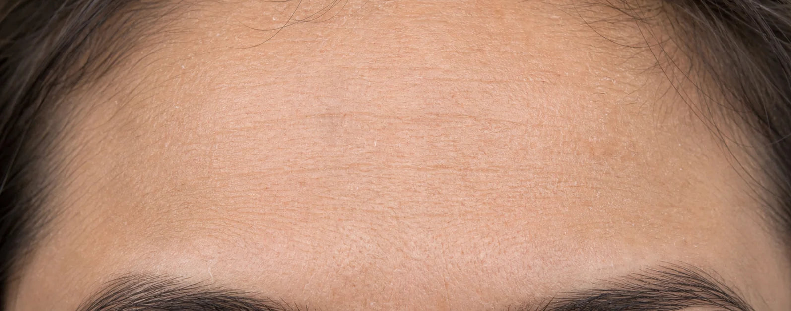 Close-up of a forehead before use: visible horizontal lines across the brow