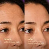 Before and after: visible forehead lines, then smoother-looking skin